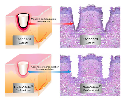 Thermal-profile